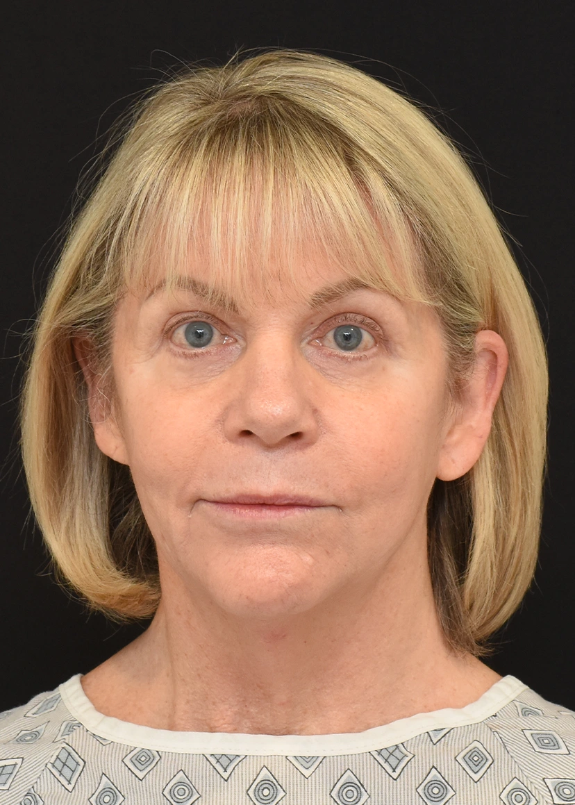 Deep Plane Facelift Patient 30 Set 1 Before