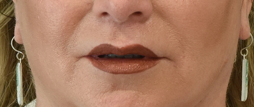Lip Lift Patient 7 Set 1 After