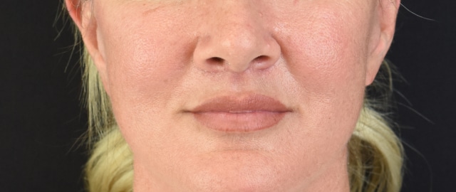 Lip Lift Patient 18 Set 1 After