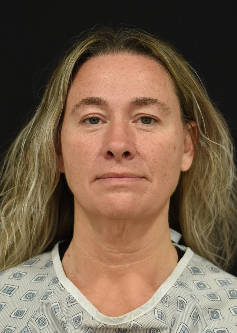 Extended Deep Plane Facelift Patient 3 Set 1 Before