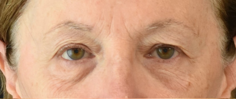 Eyelid Surgery Patient 4 Set 1 Before