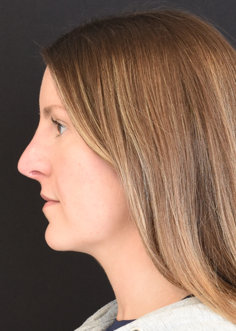 Rhinoplasty Patient 9 Set 3 After