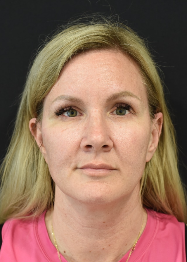 Extended Neck Lift Patient 47 Set 1 Before