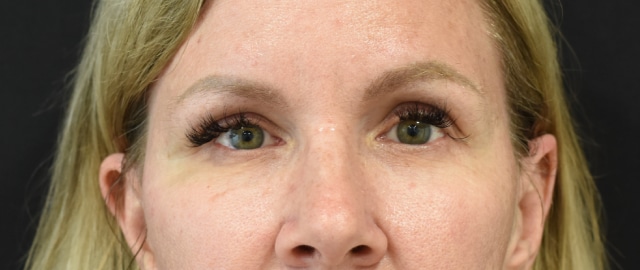 Brow Lift Patient 18 Set 1 Before