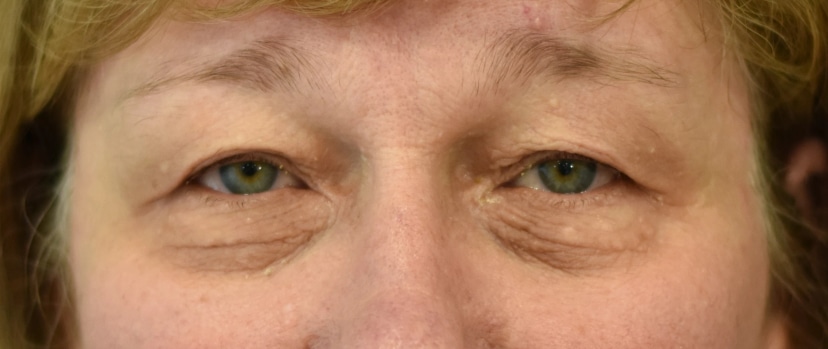 Eyelid Surgery Patient 8 Set 1 Before