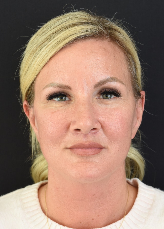 Extended Neck Lift Patient 47 Set 1 After